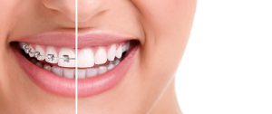 Read more about the article Adult Orthodontics