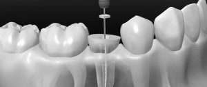 Read more about the article Root Canal Treatment