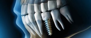 Read more about the article Dental Implantology